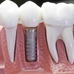 The Best Dental Implant Options for You